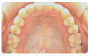 V字歯列・顎関節症