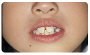 前歯の凹凸　小児矯正